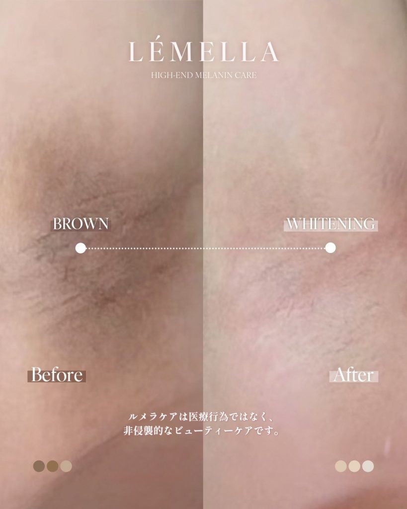 脇の黒ずみ除去!原因から即効黒ずみ除去「ルメラ」まで徹底解説! 3 ルメラの施術事例 脇