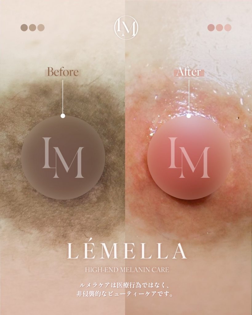 2025年10月版【ルメラの施術事例集:乳首(乳輪)】| 黒ずみ除去ルメラ 11 ルメラ 乳首 乳輪 ビフォーアフター写真