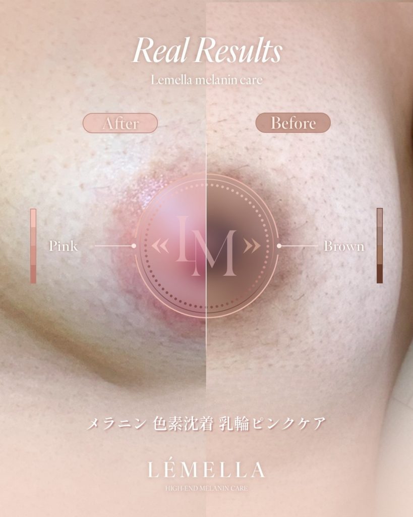 2025年10月版【ルメラの施術事例集:乳首(乳輪)】| 黒ずみ除去ルメラ 15 ルメラ 乳首 乳輪 ビフォーアフター写真