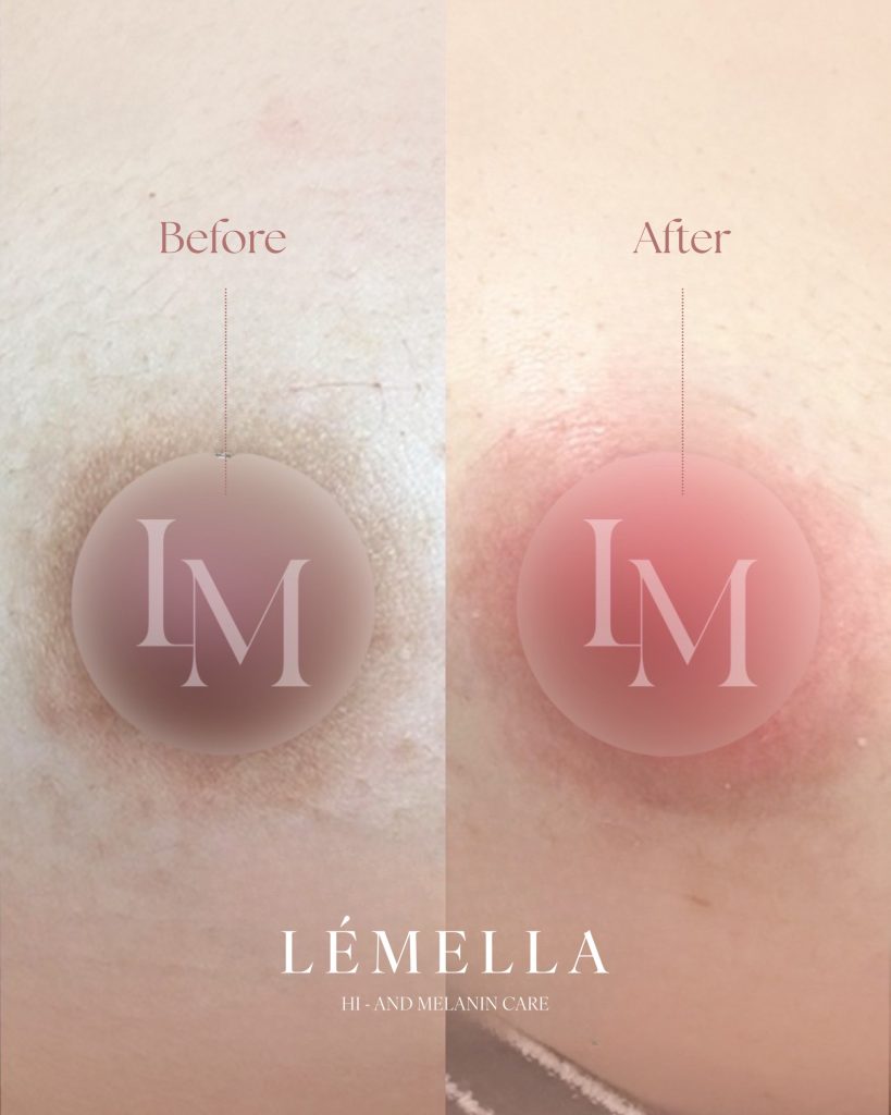 2025年10月版【ルメラの施術事例集:乳首(乳輪)】| 黒ずみ除去ルメラ 13 ルメラ 乳首 乳輪 ビフォーアフター写真