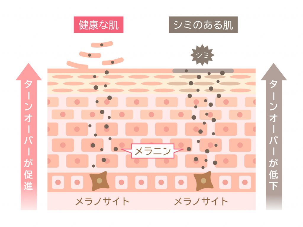 ルメラでデリケートゾーンの黒ずみを、皆さんが本来もっている赤ちゃんのころの肌色に戻しませんか？今回はデリケートゾーンの黒ずみの原因を細かくご説明させていただきます。