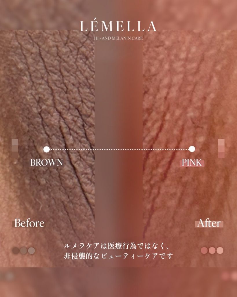 ルメラの施術例　VIO　デリケートゾーン