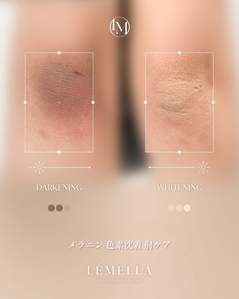 ルメラの施術例　脇