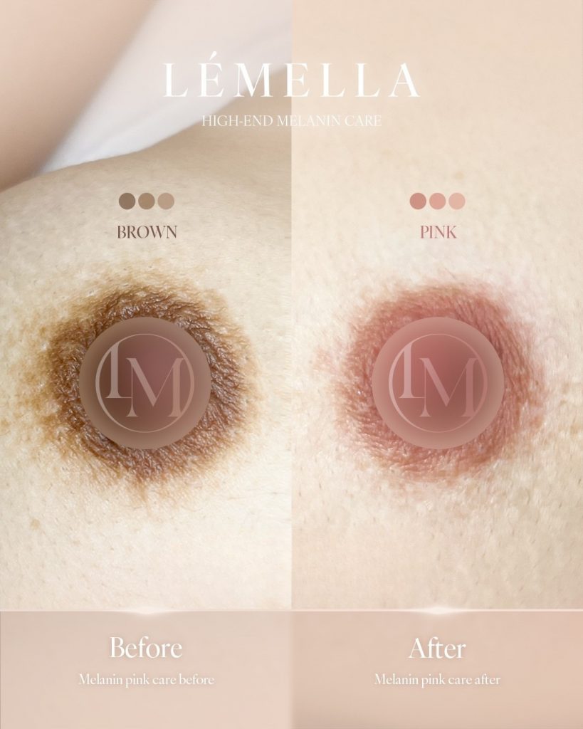 2025年10月版【ルメラの施術事例集:乳首(乳輪)】| 黒ずみ除去ルメラ 7 ルメラ 乳首 乳輪 ビフォーアフター写真