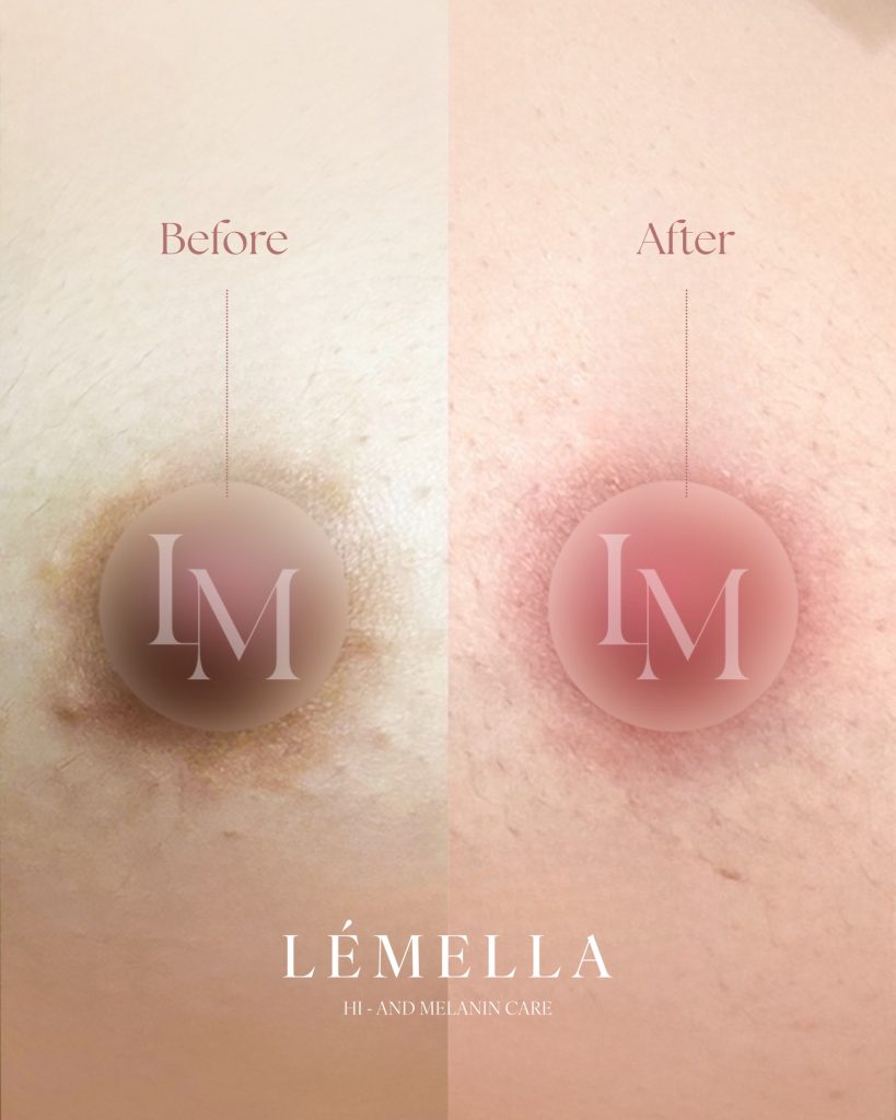 2025年10月版【ルメラの施術事例集:乳首(乳輪)】| 黒ずみ除去ルメラ 12 ルメラ 乳首 乳輪 ビフォーアフター写真