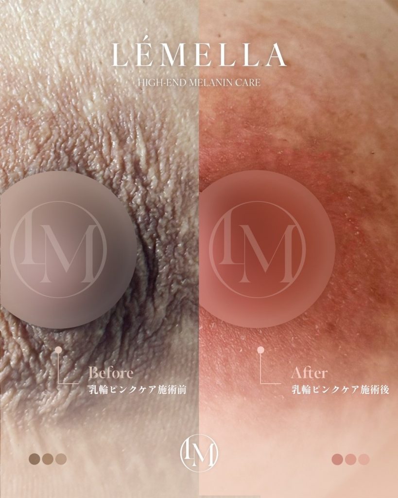 2025年10月版【ルメラの施術事例集:乳首(乳輪)】| 黒ずみ除去ルメラ 10 ルメラ 乳首 乳輪 ビフォーアフター写真