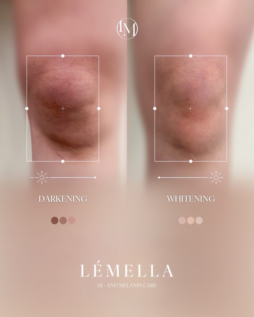 脇の黒ずみ除去!原因から即効黒ずみ除去「ルメラ」まで徹底解説! 5 「脇の黒ずみ、何とかしたい!」そう悩むあなたへ!この記事では、あなたの脇の黒ずみが「埋没毛・毛穴詰まり型」か「色素沈着型」かを見極め、自己処理や摩擦など日常生活に潜む根本原因を徹底解説します。