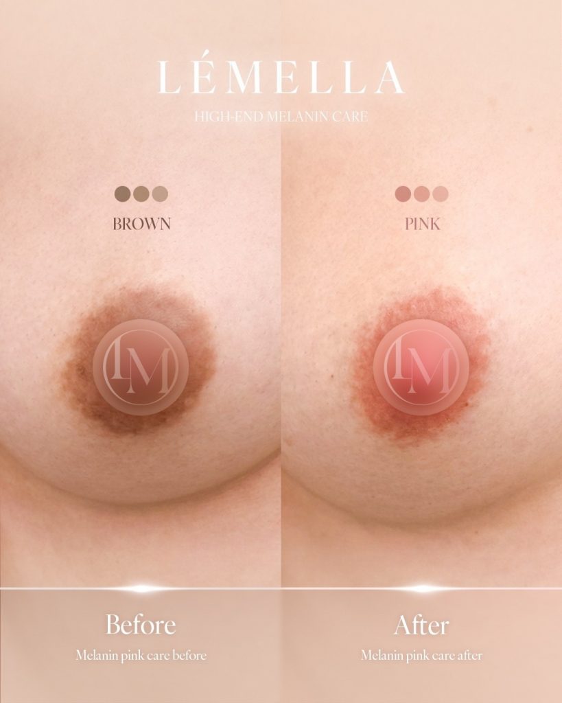 2025年10月版【ルメラの施術事例集:乳首(乳輪)】| 黒ずみ除去ルメラ 5 ルメラ 乳首 乳輪 ビフォーアフター写真