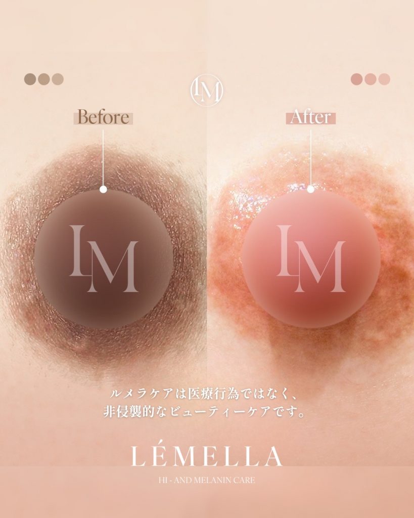 2025年10月版【ルメラの施術事例集:乳首(乳輪)】| 黒ずみ除去ルメラ 8 ルメラ 乳首 乳輪 ビフォーアフター写真