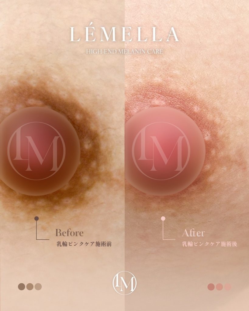 2025年10月版【ルメラの施術事例集:乳首(乳輪)】| 黒ずみ除去ルメラ 6 ルメラ 乳首 乳輪 ビフォーアフター写真