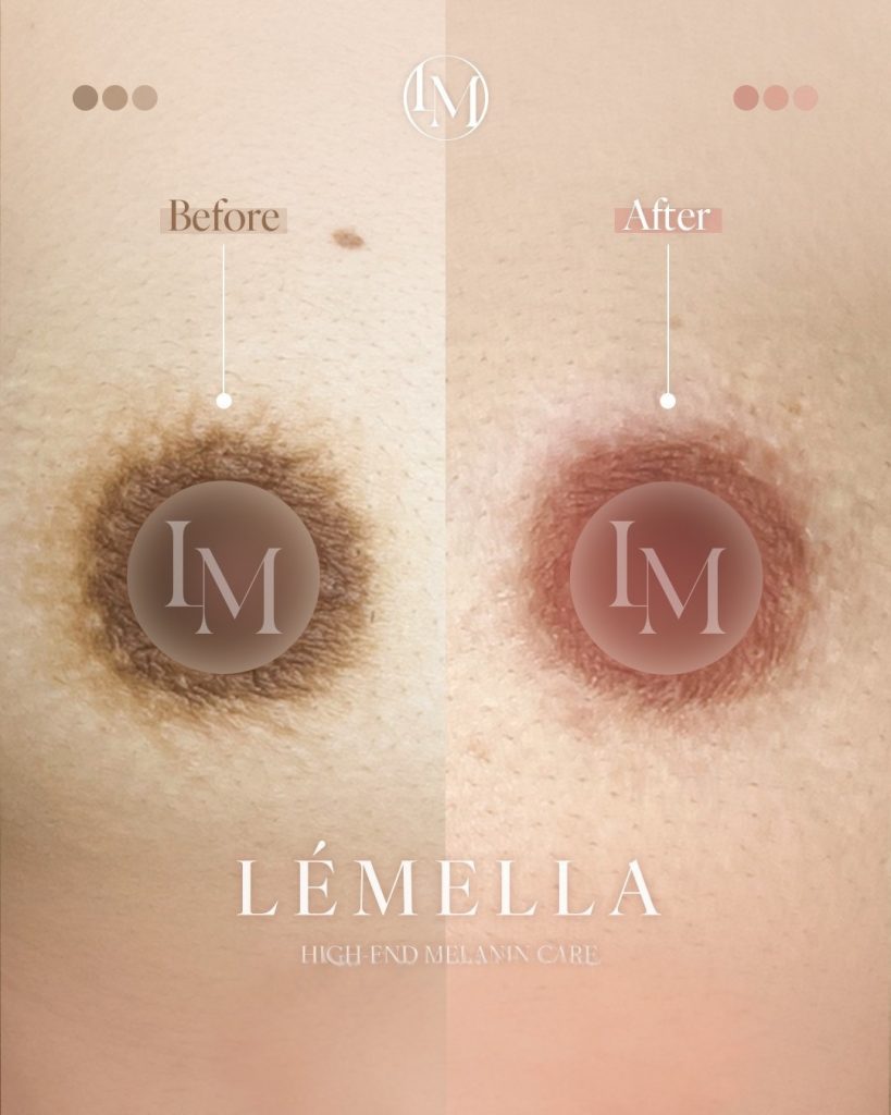 2025年10月版【ルメラの施術事例集:乳首(乳輪)】| 黒ずみ除去ルメラ 4 ルメラ 乳首 乳輪 ビフォーアフター写真