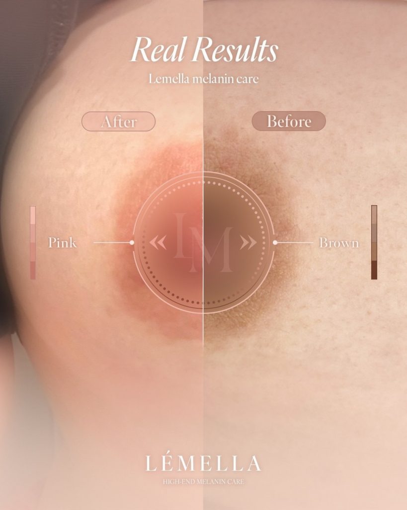 2025年10月版【ルメラの施術事例集:乳首(乳輪)】| 黒ずみ除去ルメラ 14 ルメラ 乳首 乳輪 ビフォーアフター写真