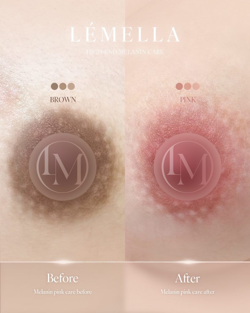 ルメラの施術例　乳輪