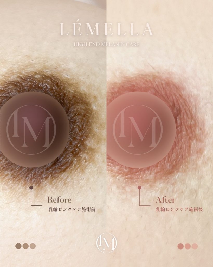 2025年10月版【ルメラの施術事例集:乳首(乳輪)】| 黒ずみ除去ルメラ 2 ルメラ 乳首 乳輪 ビフォーアフター写真