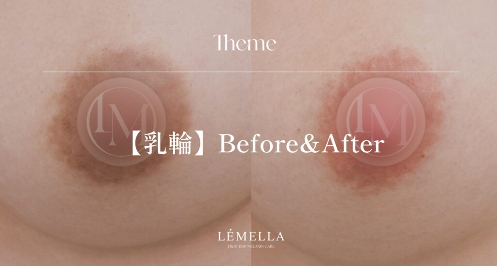 2025年10月版【ルメラの施術事例集：乳首(乳輪)】| 黒ずみ除去ルメラ
