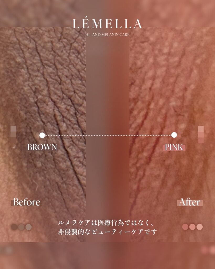 2025年11月版【ルメラの施術事例集:デリケートゾーン(VIO)】| 黒ずみ除去ルメラ 5 多くご要望をいただいておりました、デリケートゾーン(VIO)のビフォーアフター写真を今日はご紹介をさせていただきたいと思います!デリケートゾーン(VIO)は、日常的に衣類で摩擦されてているので、黒ずみやすい部位ですが、ルメラならそんな黒ずみも肌本来のピンク色に戻すことが可能です!