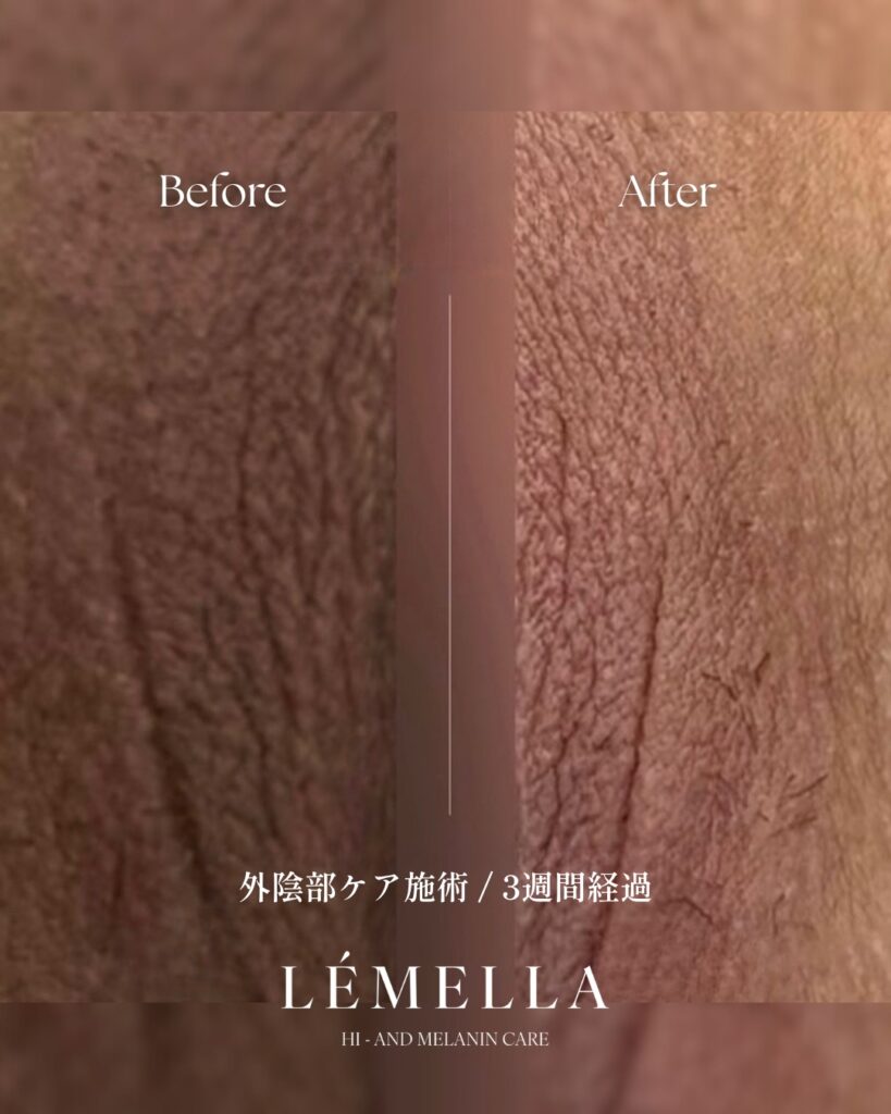 2025年11月版【ルメラの施術事例集:デリケートゾーン(VIO)】| 黒ずみ除去ルメラ 6 多くご要望をいただいておりました、デリケートゾーン(VIO)のビフォーアフター写真を今日はご紹介をさせていただきたいと思います!デリケートゾーン(VIO)は、日常的に衣類で摩擦されてているので、黒ずみやすい部位ですが、ルメラならそんな黒ずみも肌本来のピンク色に戻すことが可能です!