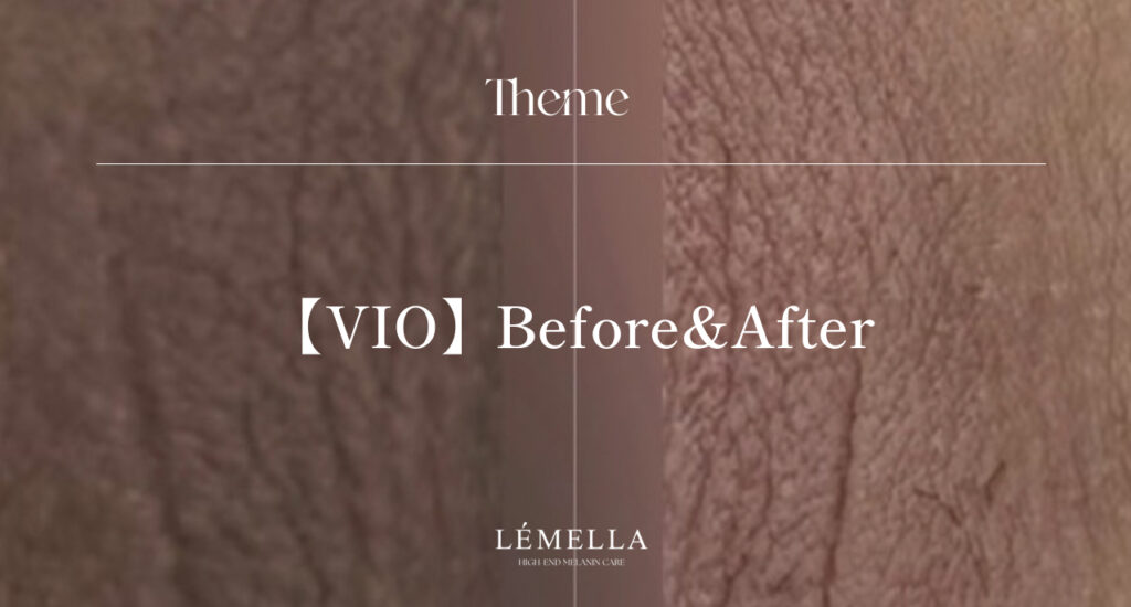ルメラ VIOビフォーアフター