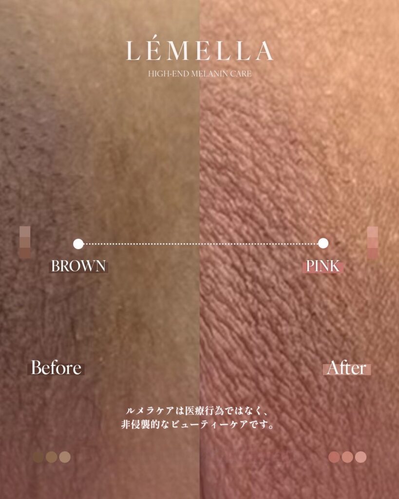 2025年11月版【ルメラの施術事例集:デリケートゾーン(VIO)】| 黒ずみ除去ルメラ 4 多くご要望をいただいておりました、デリケートゾーン(VIO)のビフォーアフター写真を今日はご紹介をさせていただきたいと思います!デリケートゾーン(VIO)は、日常的に衣類で摩擦されてているので、黒ずみやすい部位ですが、ルメラならそんな黒ずみも肌本来のピンク色に戻すことが可能です!