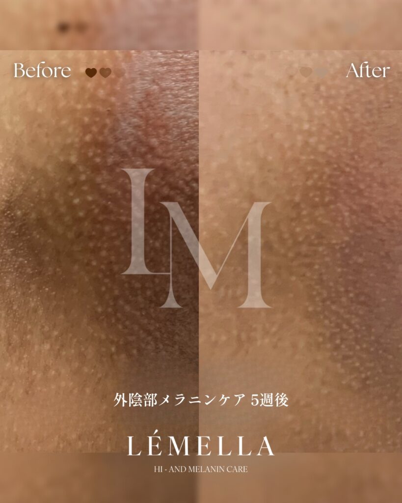 2025年11月版【ルメラの施術事例集:デリケートゾーン(VIO)】| 黒ずみ除去ルメラ 3 多くご要望をいただいておりました、デリケートゾーン(VIO)のビフォーアフター写真を今日はご紹介をさせていただきたいと思います!デリケートゾーン(VIO)は、日常的に衣類で摩擦されてているので、黒ずみやすい部位ですが、ルメラならそんな黒ずみも肌本来のピンク色に戻すことが可能です!